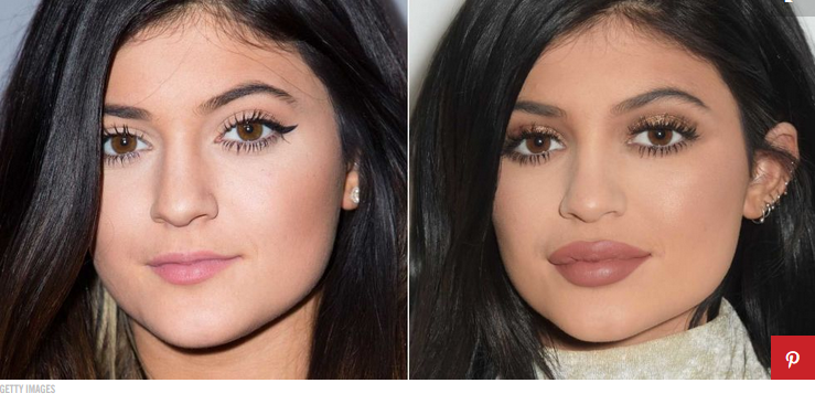 kylie jenner lips philly