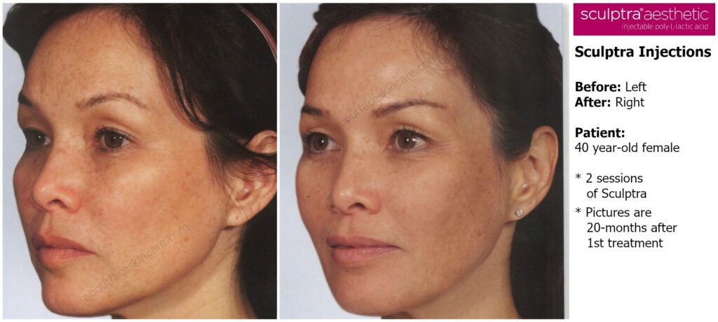 Sculptra injections before and after philadelphia