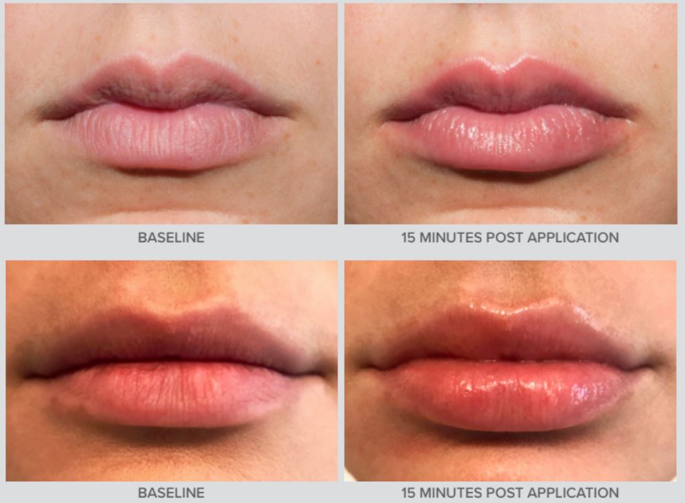 Transforming Your Pout With Lip Injections in Philadelphia