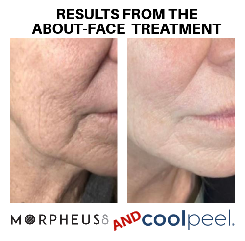 Morpheus8 and CoolPeel CO2 results