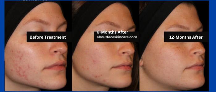 AviClear Acne Laser Treatments Philadelphia