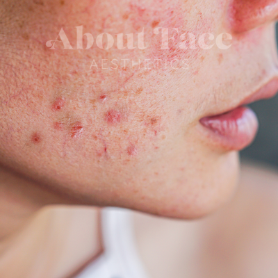 Acne consultation at About Face Aesthetics Philadelphia