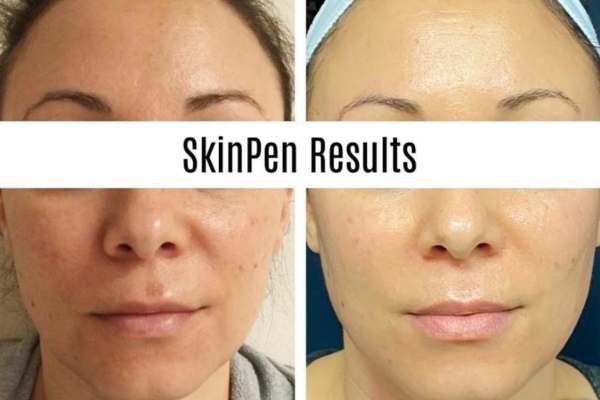 skinpen microneedling in philadelphia treatment results
