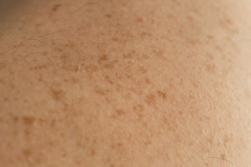 Close up detail of the bare skin with scattered moles and freckles. Our skin rejuvenation in Philadelphia can address these for more even, youthful skin tone.